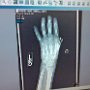 My Hand X-Rays